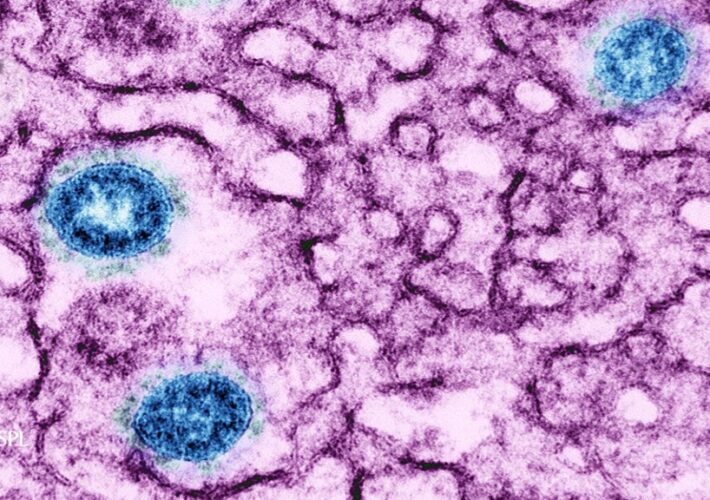 Could long Covid be linked to herpes viruses? Early data offer a hint