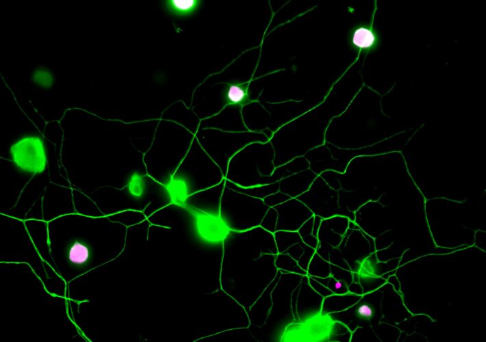 Antipsychotic Drug Opens New Pathway To Beat Chronic Pain